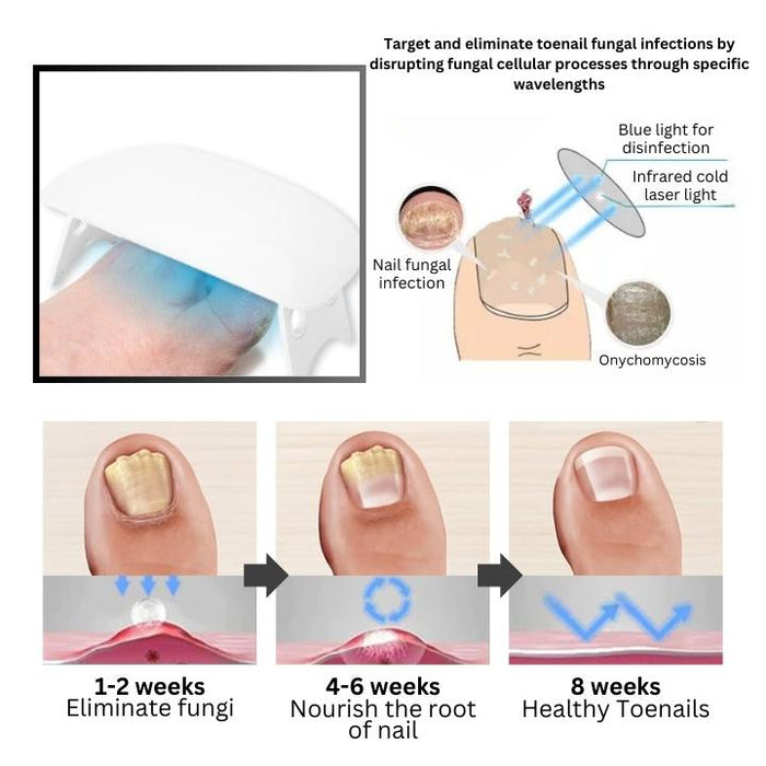 LuzSanar | Fototerapia Innovadora para Hongos de Uñas